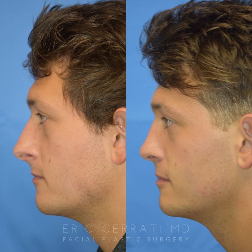 Male patient before and after rhinoplasty
