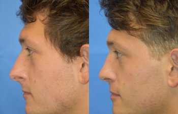Male patient before and after rhinoplasty