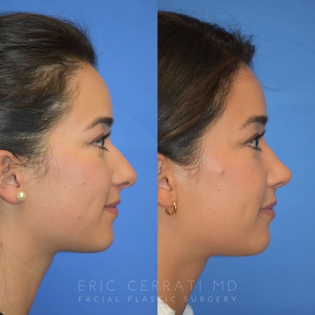 Female patient before and after rhinoplasty - right side