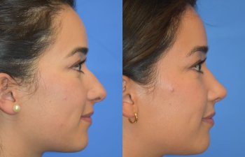 Female patient before and after rhinoplasty - right side