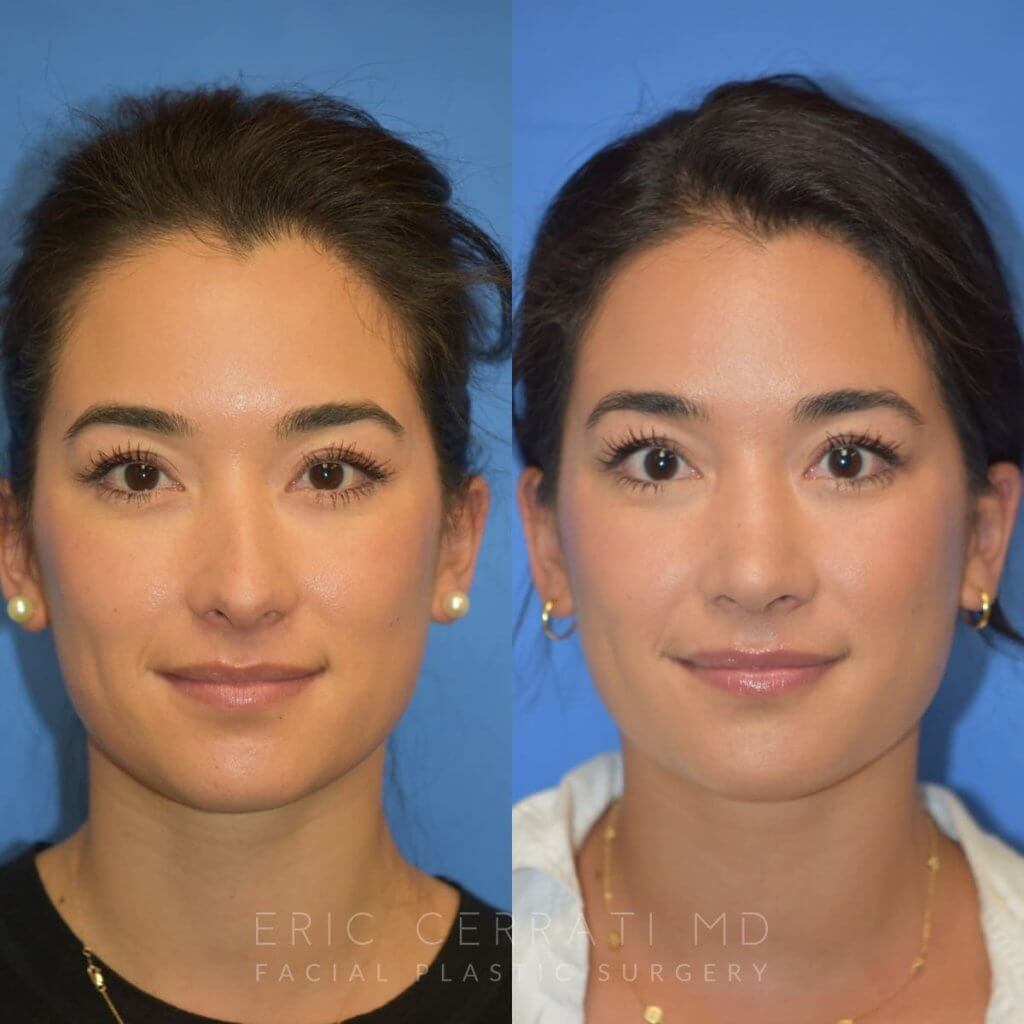 Female patient before and after rhinoplasty - front