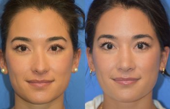 Female patient before and after rhinoplasty - front
