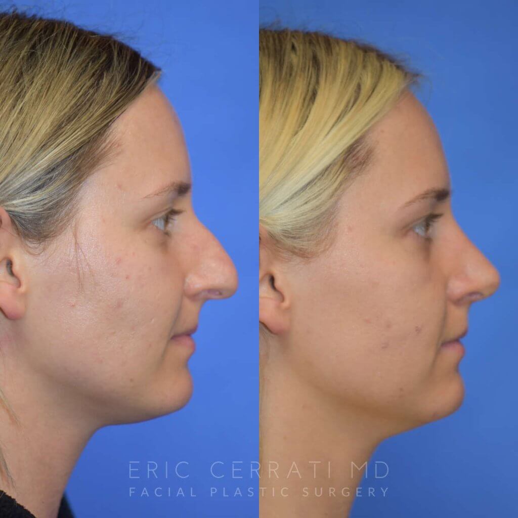 Female patient before and after rhinoplasty - right side