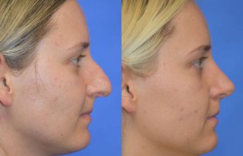 Female patient before and after rhinoplasty - right side