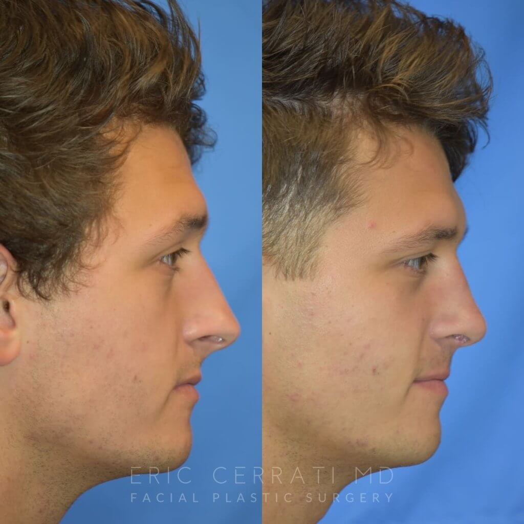 Male patient before and after rhinoplasty