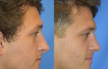 Male patient before and after rhinoplasty