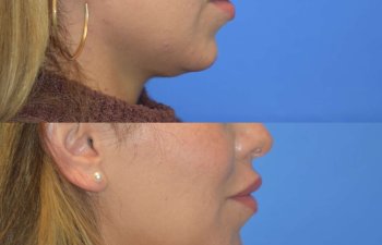 Photos of a woman's face before and after cheek reduction - right side