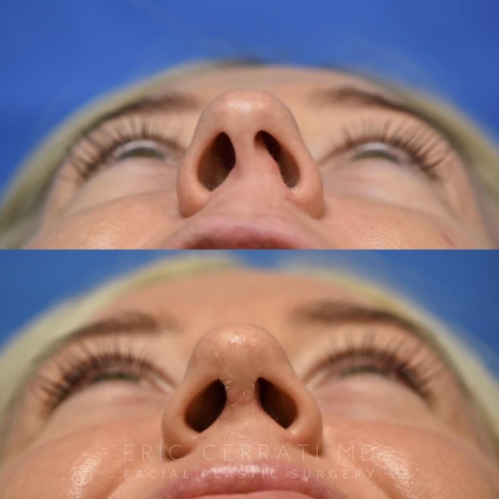 Female patient before and after rhinoplasty - base