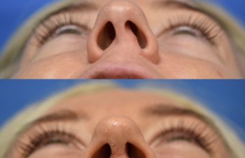Female patient before and after rhinoplasty - base