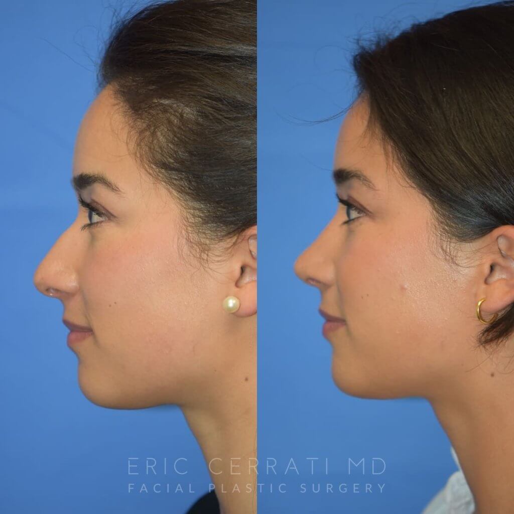 Female patient before and after rhinoplasty - right side
