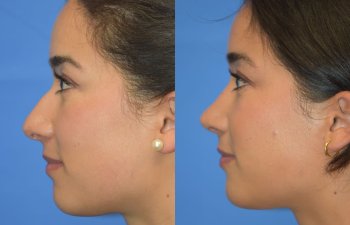 Female patient before and after rhinoplasty - right side