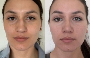 Female patient before and after rhinoplasty - front