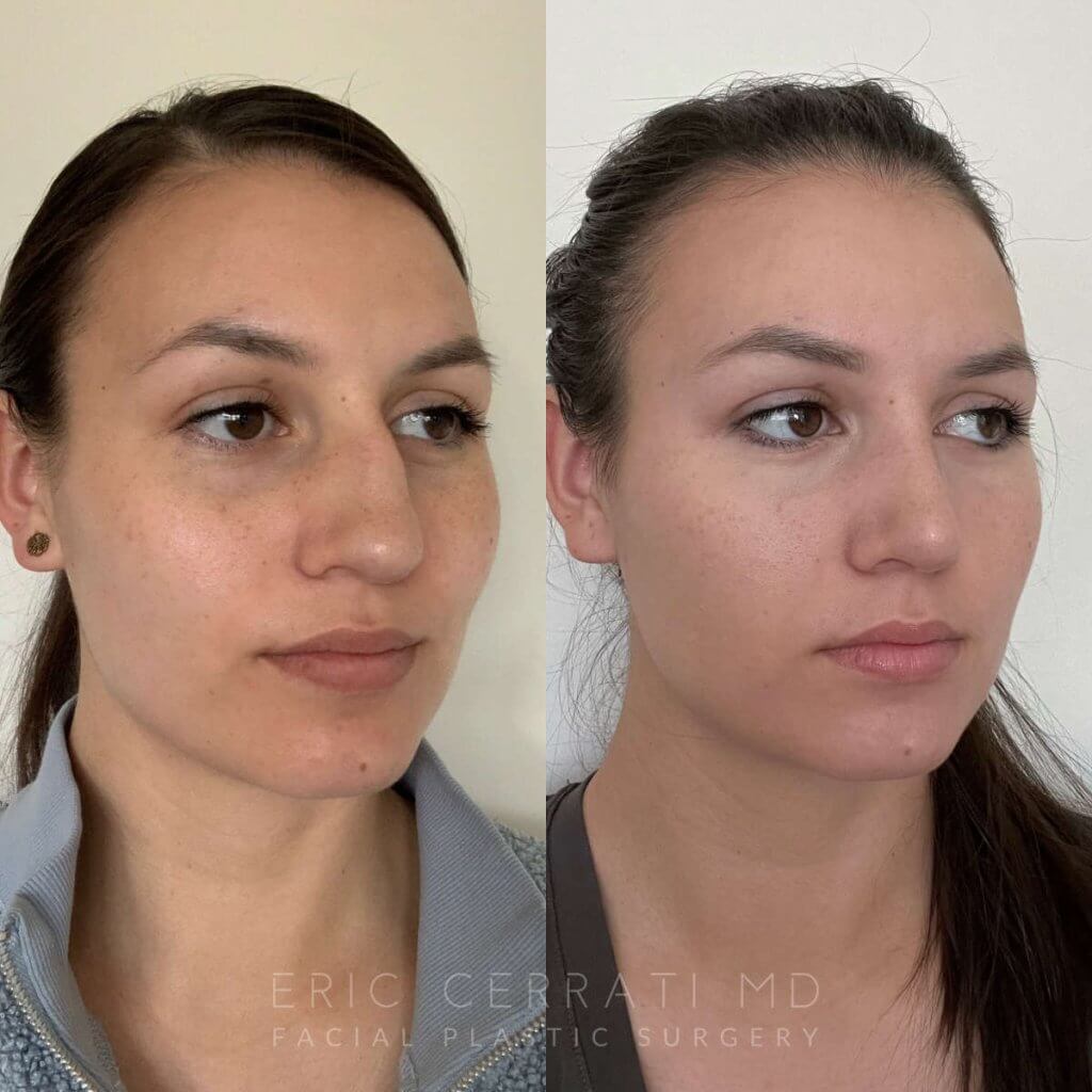 Female patient before and after rhinoplasty - right side