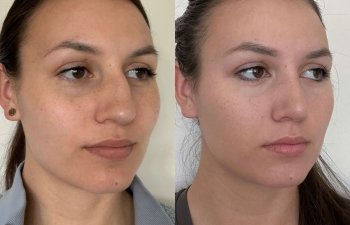 Female patient before and after rhinoplasty - right side