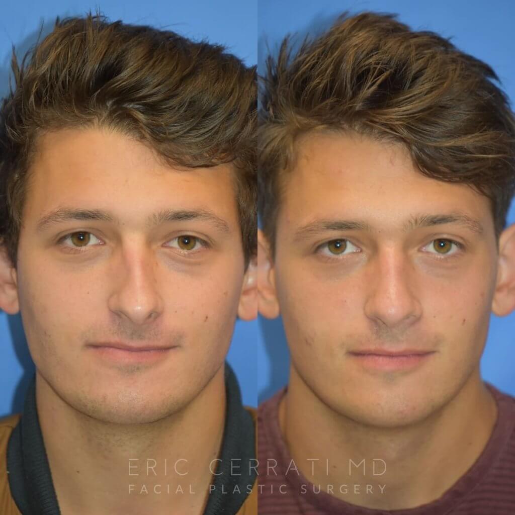Male patient before and after rhinoplasty