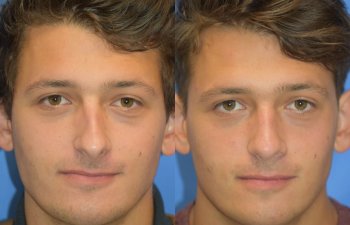 Male patient before and after rhinoplasty