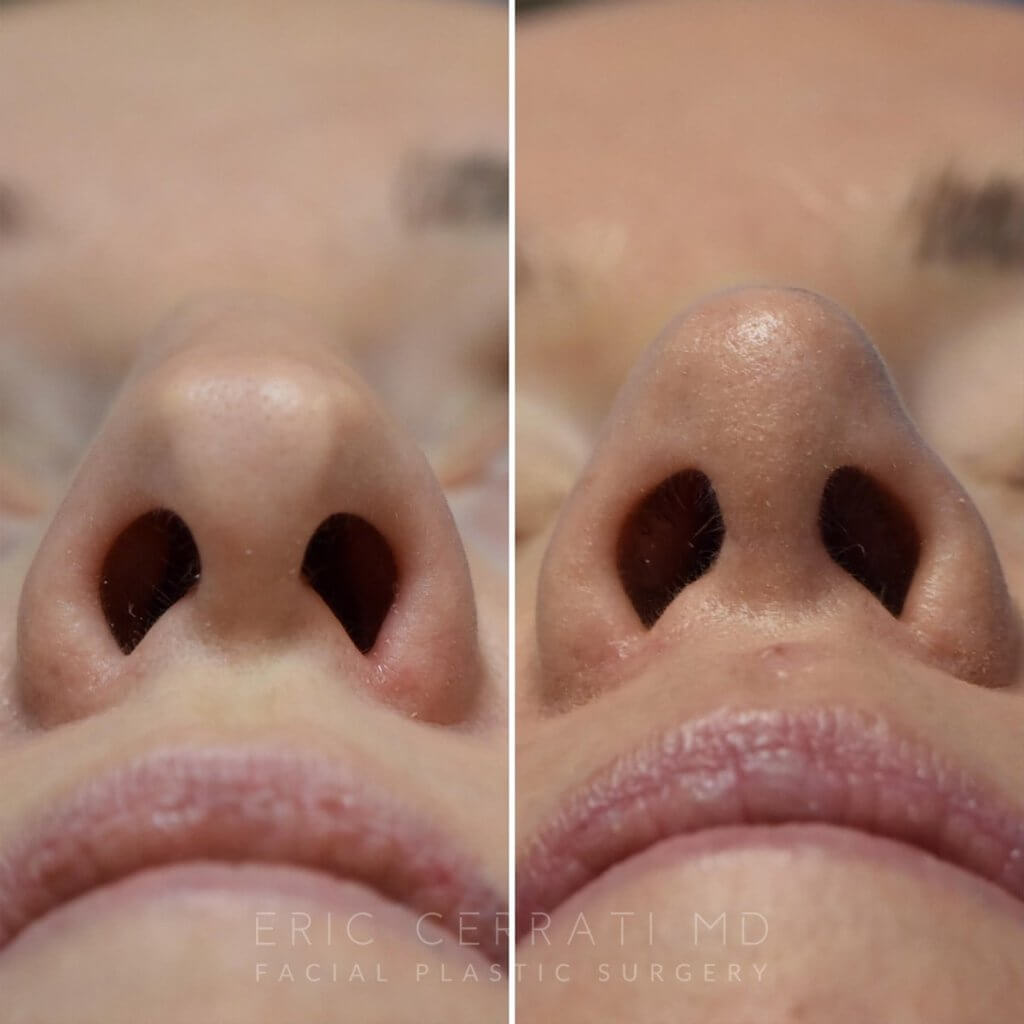 Female patient before and after rhinoplasty