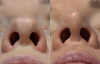 Female patient before and after rhinoplasty