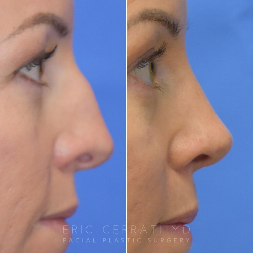 Female patient before and after rhinoplasty