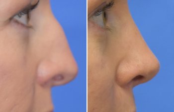 Female patient before and after rhinoplasty