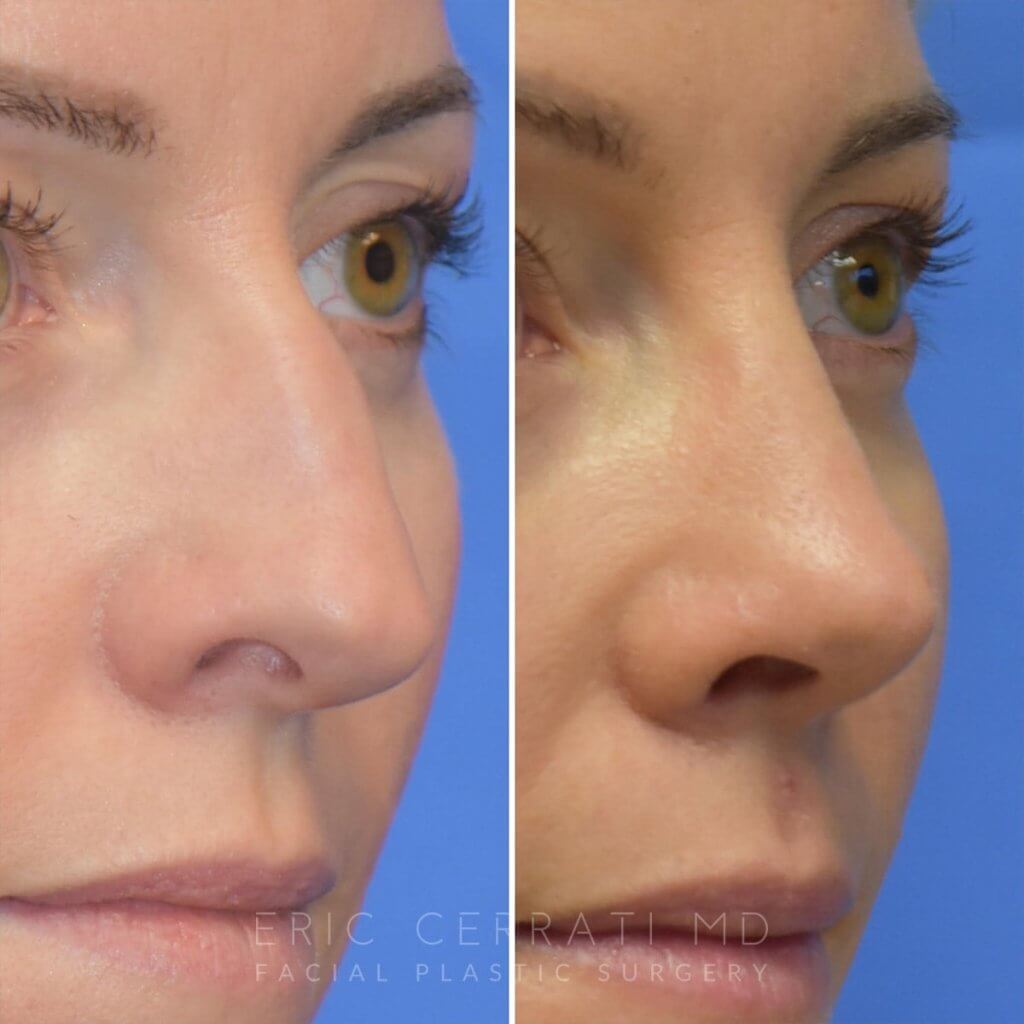 Female patient before and after rhinoplasty