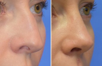 Female patient before and after rhinoplasty