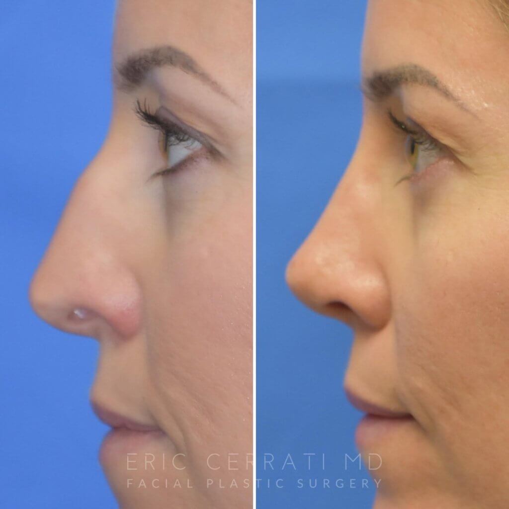 Female patient before and after rhinoplasty