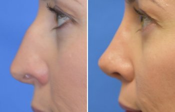 Female patient before and after rhinoplasty