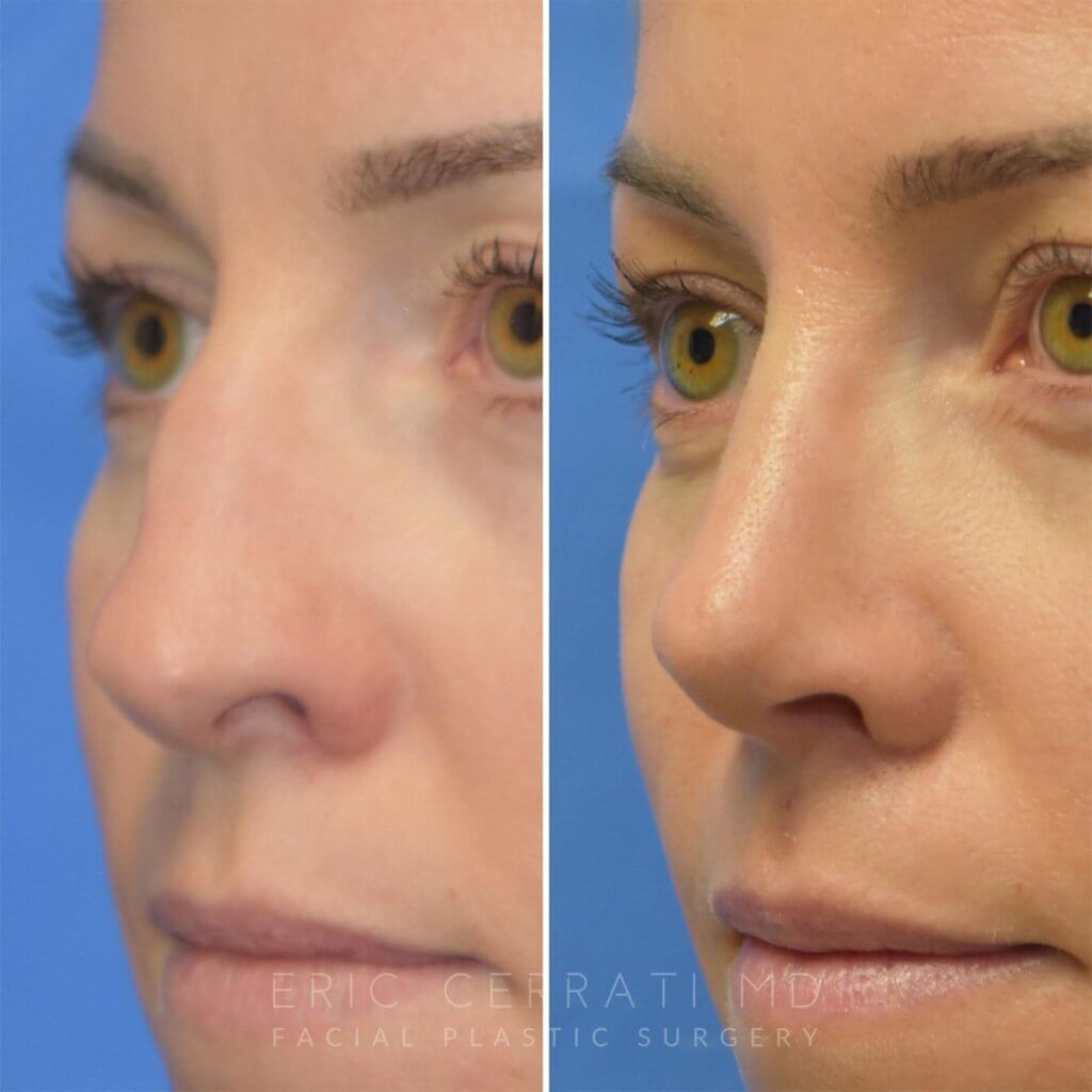 Female patient before and after rhinoplasty