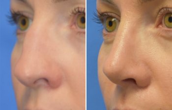 Female patient before and after rhinoplasty