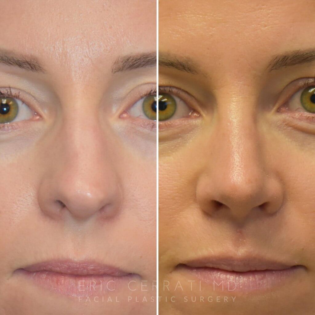 Female patient before and after rhinoplasty