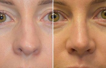 Female patient before and after rhinoplasty