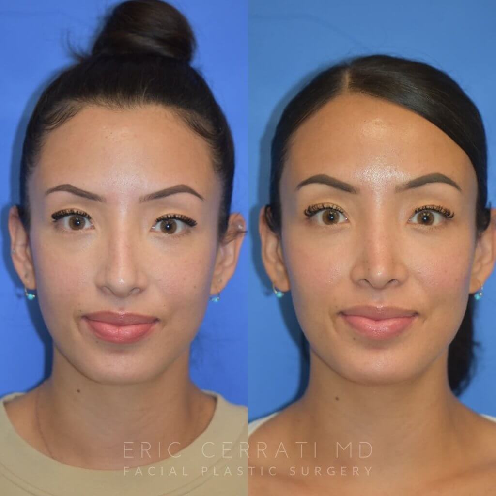 Female patient before and after rhinoplasty
