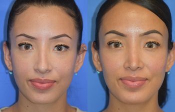 Female patient before and after rhinoplasty