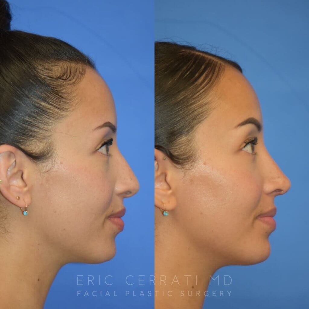 Female patient before and after rhinoplasty