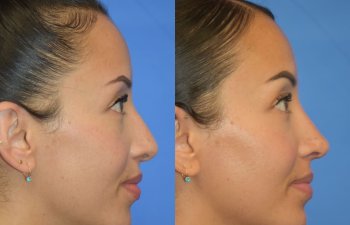 Female patient before and after rhinoplasty