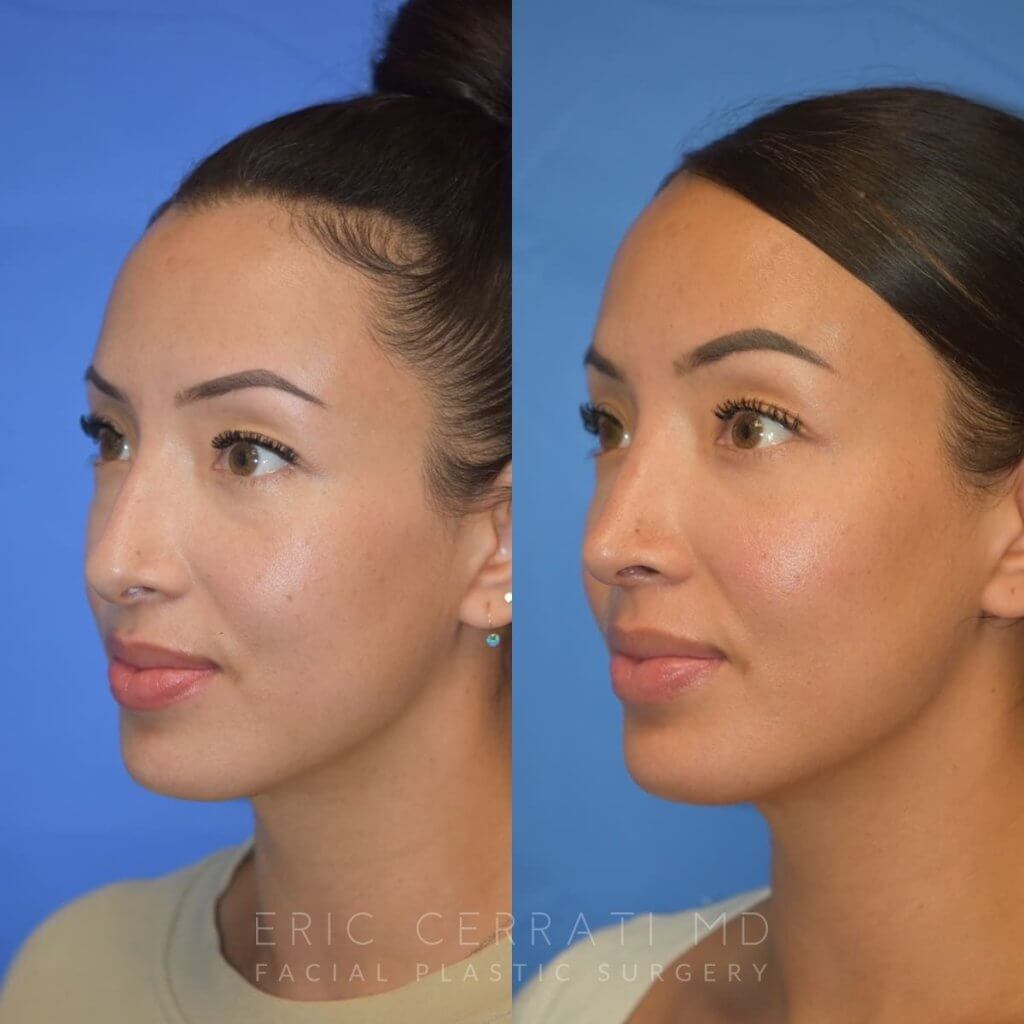 Female patient before and after rhinoplasty