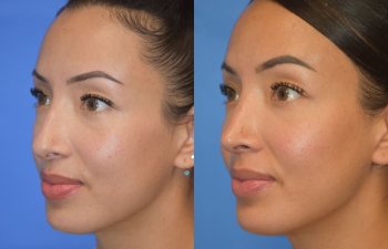 Female patient before and after rhinoplasty