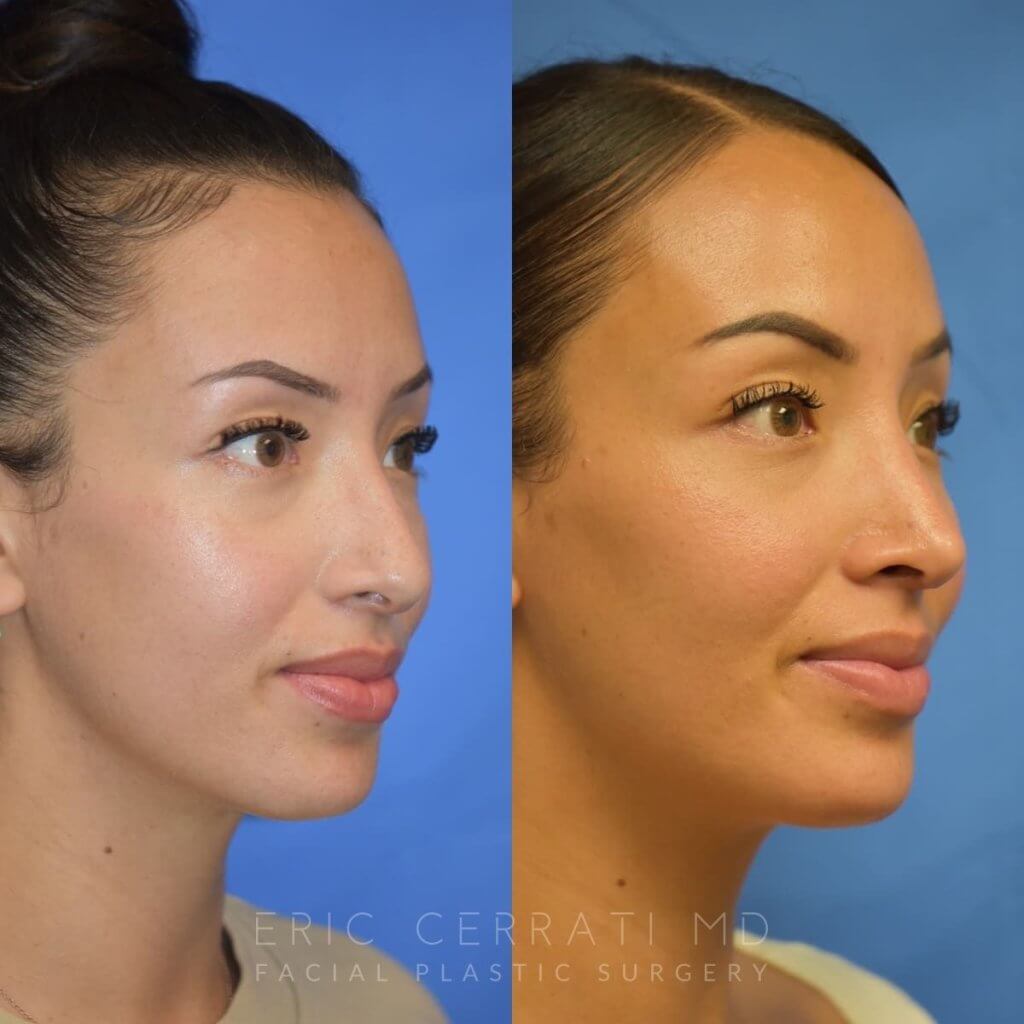 Female patient before and after rhinoplasty