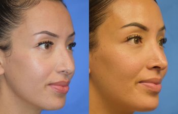 Female patient before and after rhinoplasty