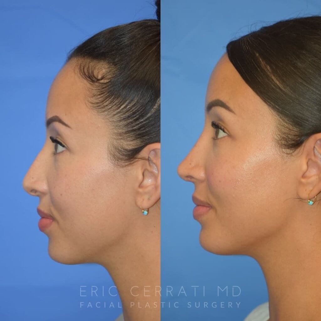 Female patient before and after rhinoplasty
