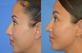 Female patient before and after rhinoplasty