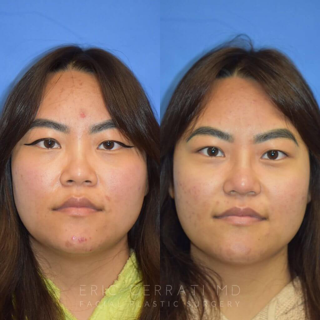 Female patient before and after rhinoplasty