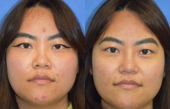 Female patient before and after rhinoplasty