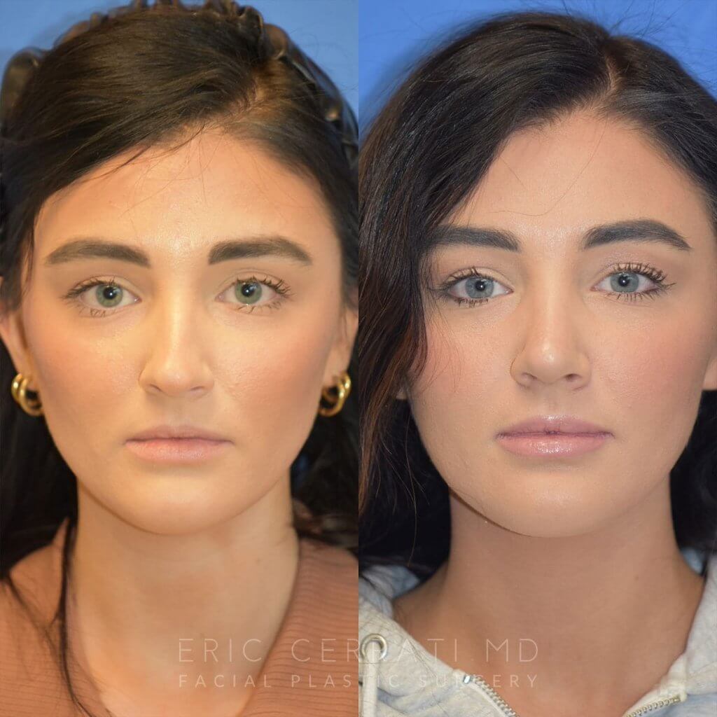 Female patient before and after rhinoplasty