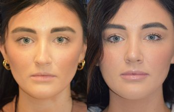 Female patient before and after rhinoplasty