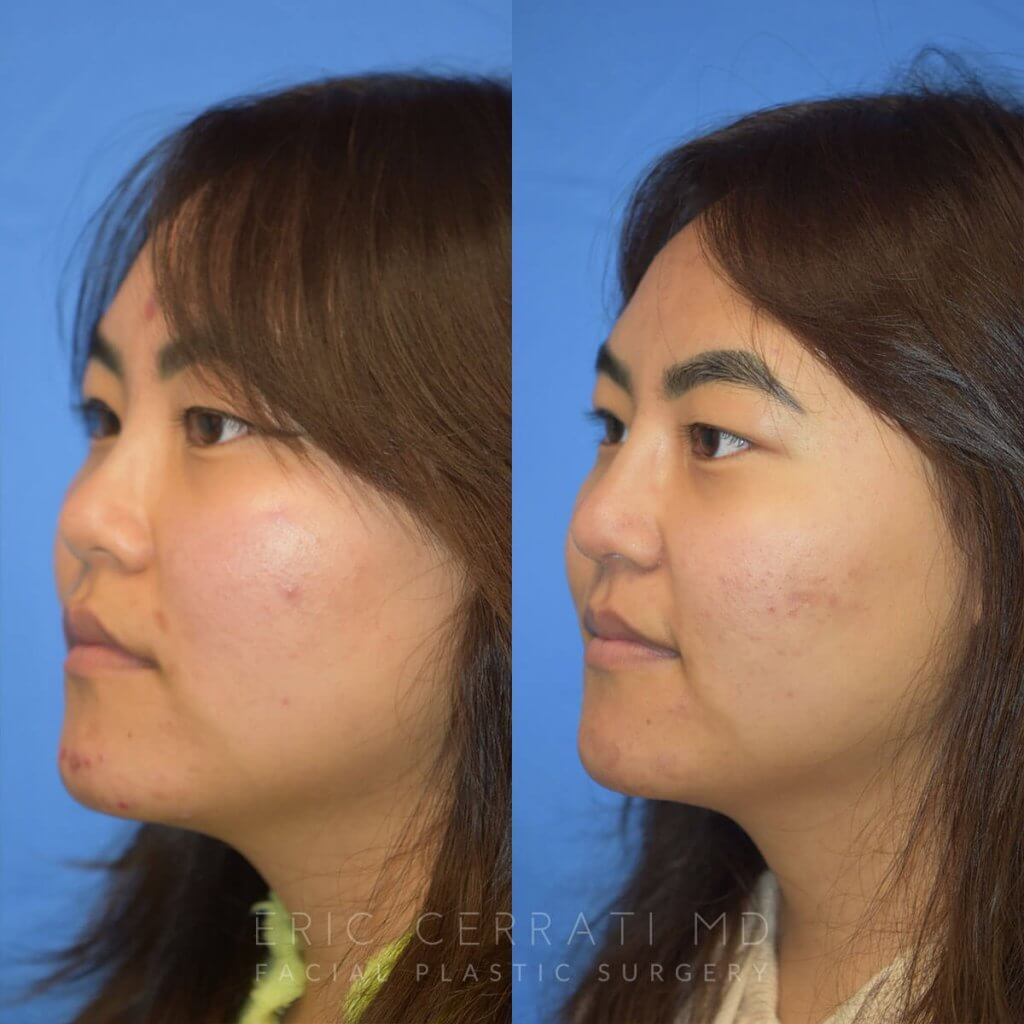 Female patient before and after rhinoplasty