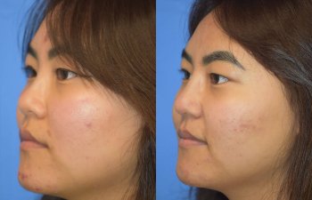 Female patient before and after rhinoplasty