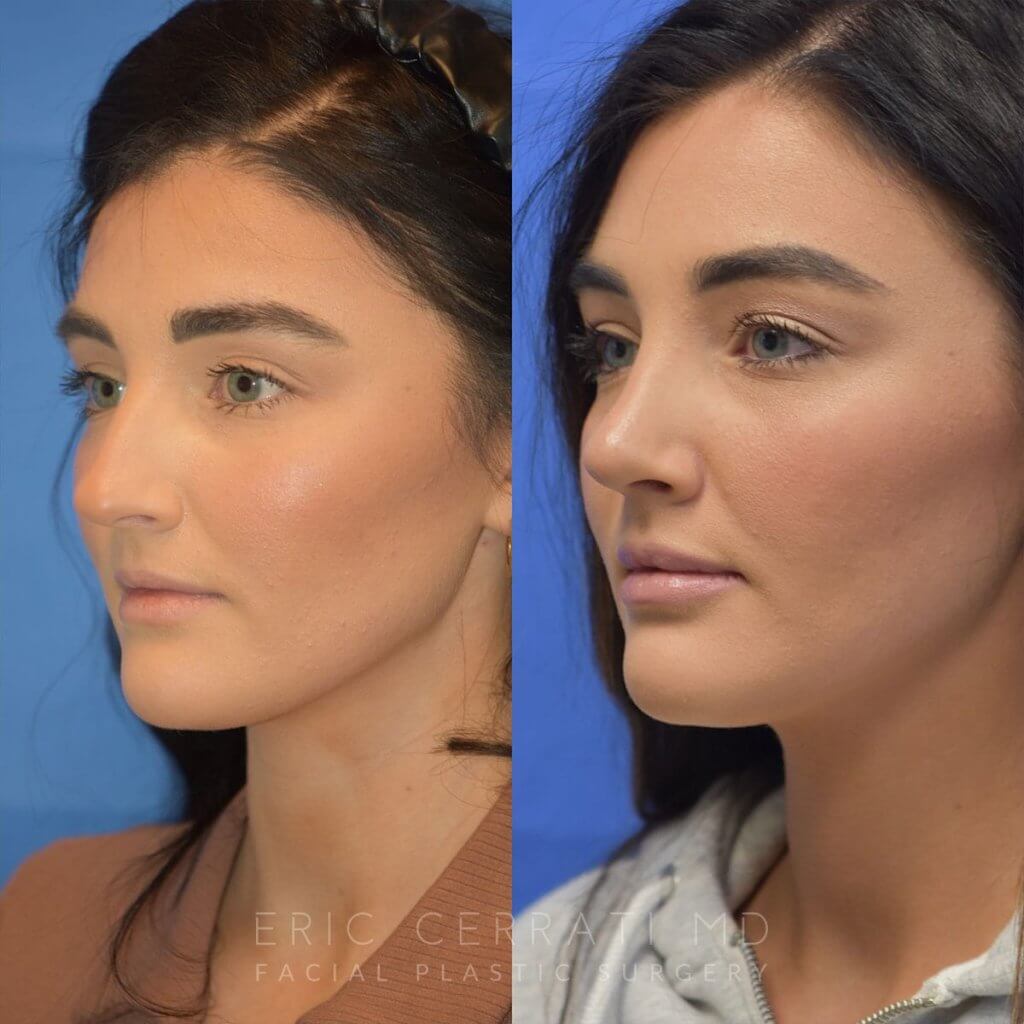 Female patient before and after rhinoplasty