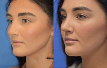 Female patient before and after rhinoplasty